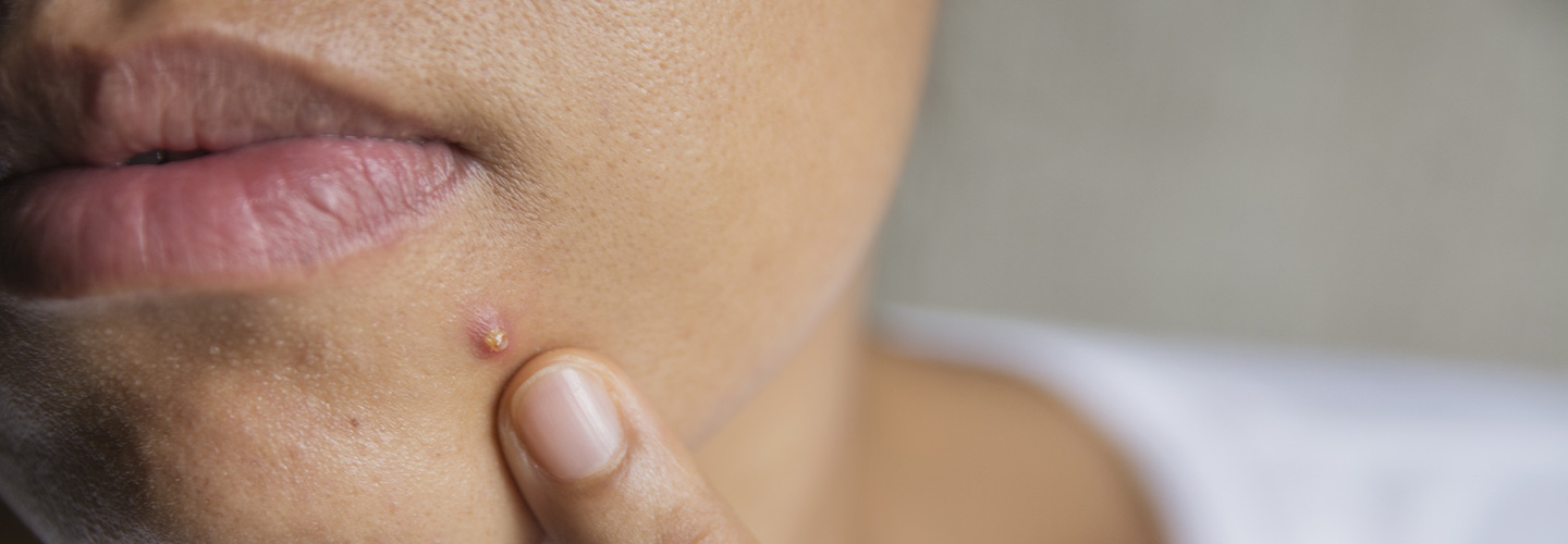 Pusteln und Eiterpickel loswerden | Eucerin